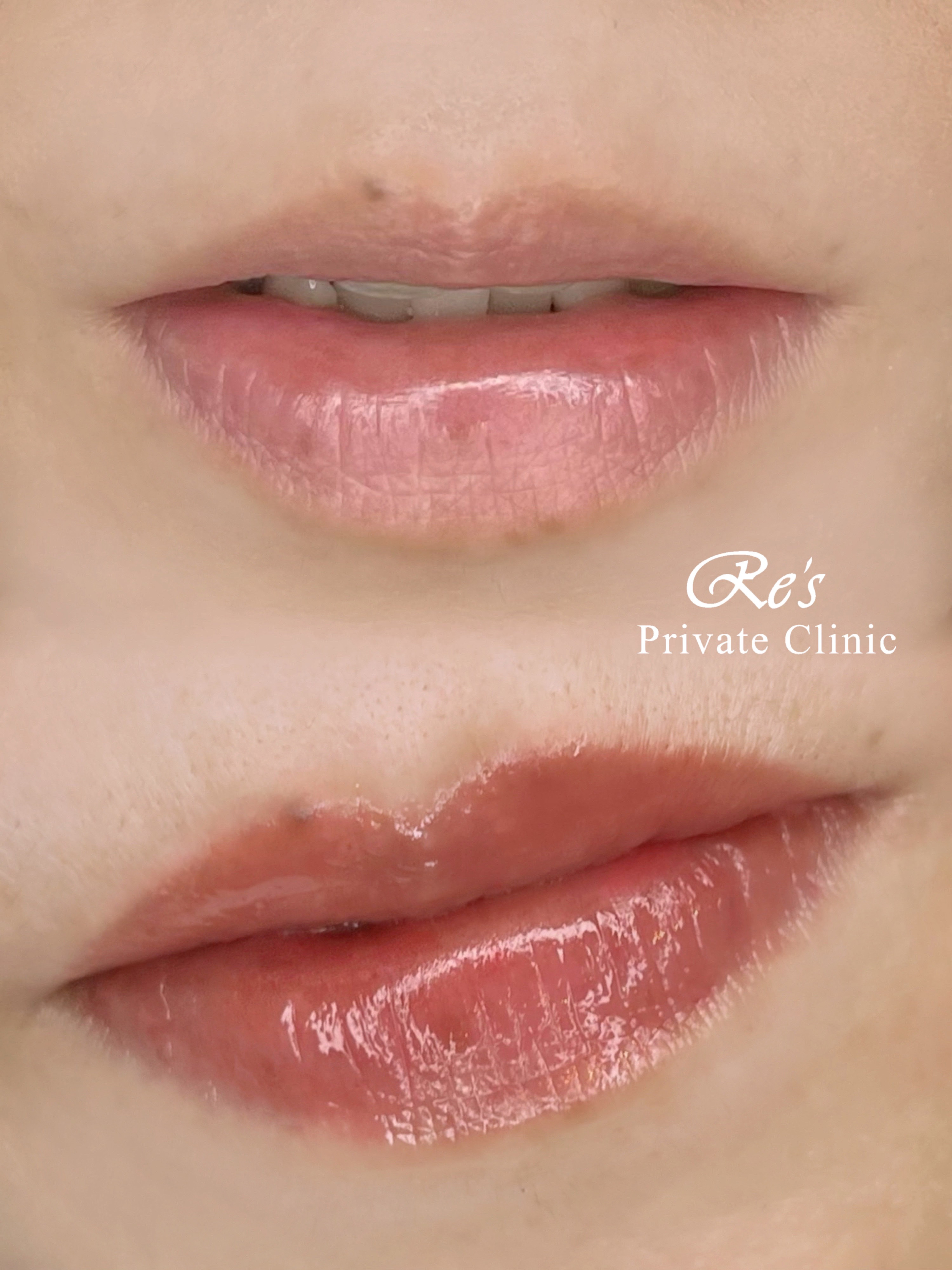 リーズプライベートクリニック｜リップアートメイクの症例