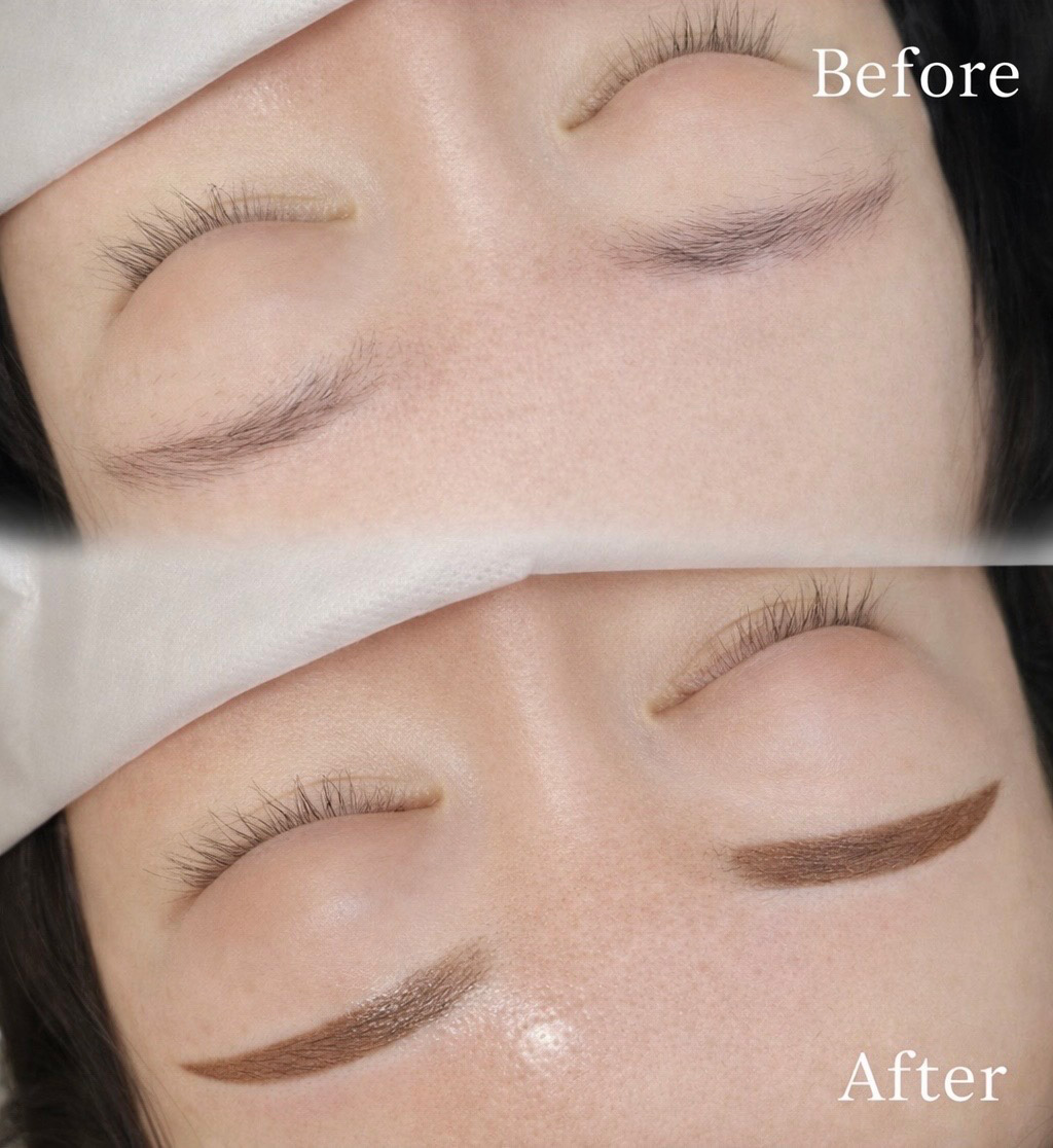リーズプライベートクリニック｜眉アートメイクの症例